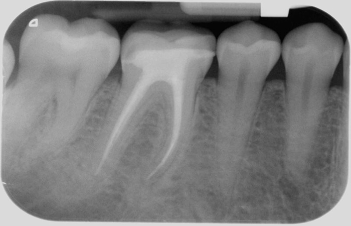 endodontie